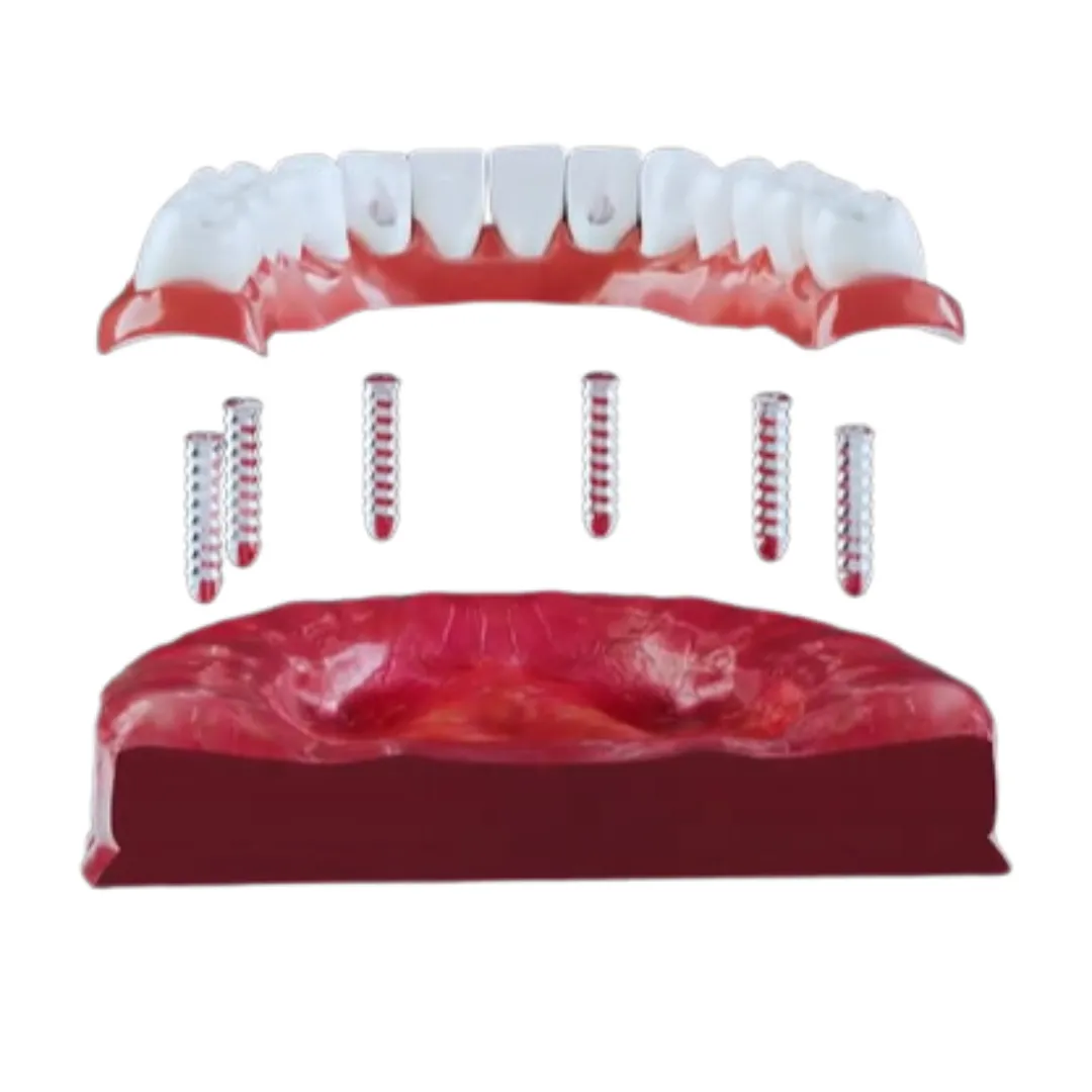 Full-Arch Dental Implants