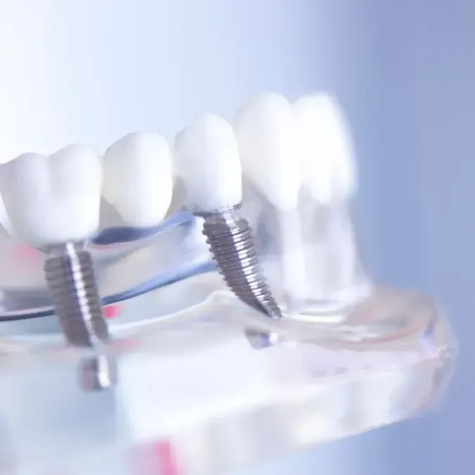 Multiple-Tooth Replacement